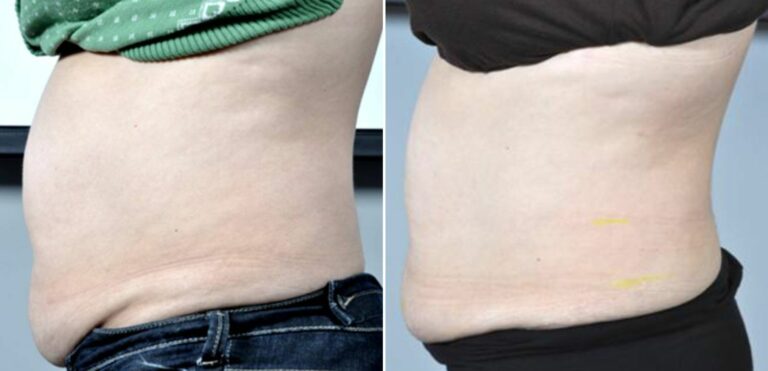 Can I Use Niacinamide After Laser Hair Removal